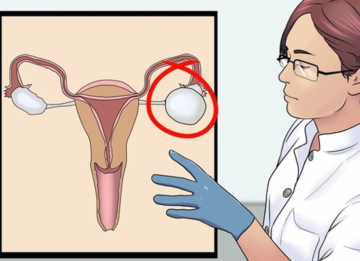 Nếu không được chữa trị sớm, bệnh buồng trứng đa nang sẽ dẫn đến sự mất cân bằng hormone, ảnh hưởng nghiêm trọng đến sức khỏe và tăng nguy cơ mắc một số bệnh Nếu không được chữa trị sớm, bệnh buồng trứng đa nang sẽ dẫn đến sự mất cân bằng hormone, ảnh hưởng nghiêm trọng đến sức khỏe và tăng nguy cơ mắc một số bệnh