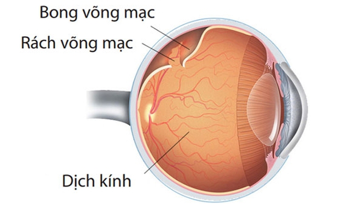 Cảnh giác với bong võng mạc ở những người cận thị - Ảnh 2.