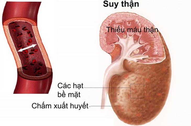 Suy thận mạn do đâu và phương pháp điều trị - Ảnh 1. Suy thận mạn do đâu và phương pháp điều trị - Ảnh 1.