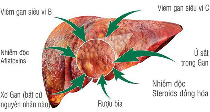 Muốn dùng thảo dược để bảo vệ gan, không có thứ gì qua được cà gai leo - Ảnh 1. Muốn dùng thảo dược để bảo vệ gan, không có thứ gì qua được cà gai leo - Ảnh 1.