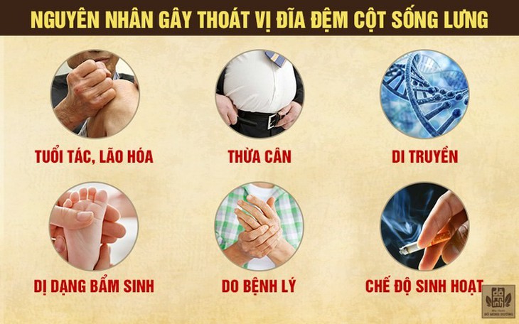 Thoát vị đĩa đệm cột sống thắt lưng là gì? Dấu hiệu và cách điều trị - Ảnh 1.