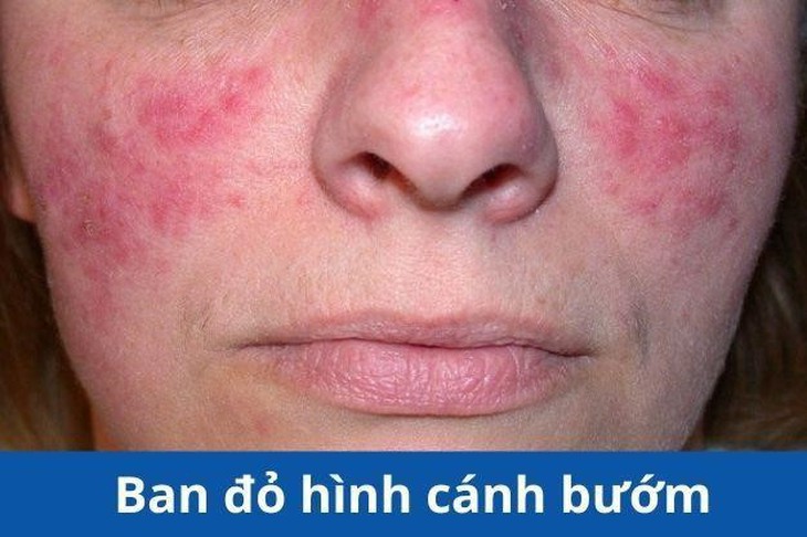 Bệnh lupus ban đỏ và cách hỗ trợ giảm nguy cơ tiến triển từ thảo dược - Ảnh 1. Bệnh lupus ban đỏ và cách hỗ trợ giảm nguy cơ tiến triển từ thảo dược - Ảnh 1.