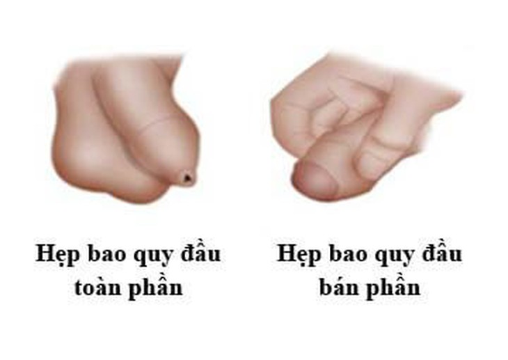 Hẹp bao quy đầu ở trẻ em và người lớn - Ảnh 1.