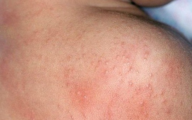 Bài thuốc đông y trị phát ban và rôm sảy