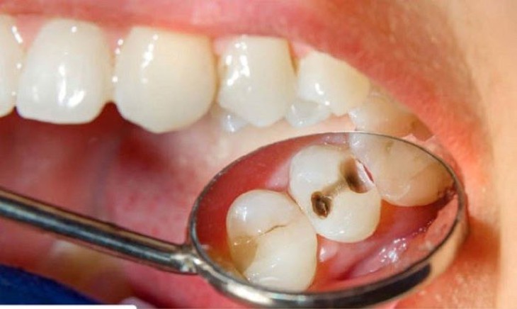 Thuốc điều trị sâu răng - Ảnh 1. Thuốc điều trị sâu răng - Ảnh 1.