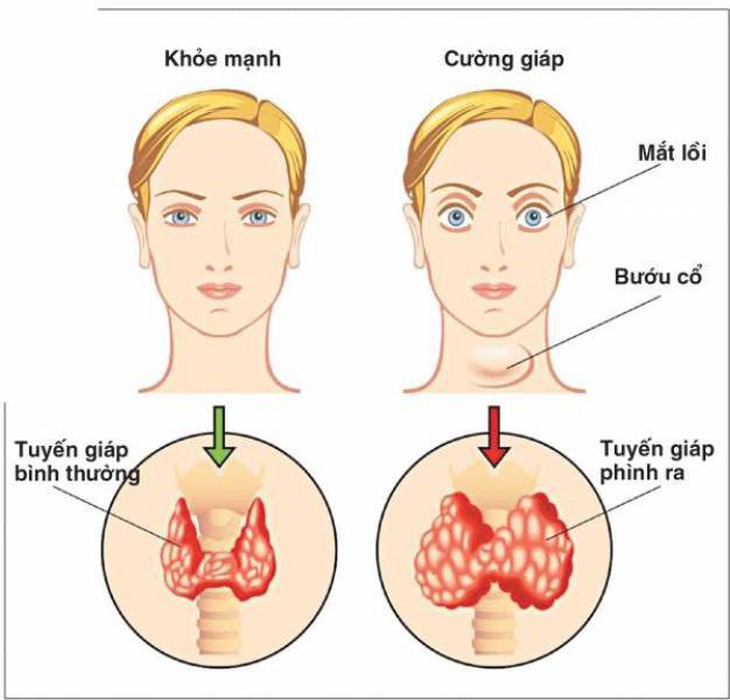 Thực phẩm đơn giản, quen thuộc giúp kiểm soát bệnh cường giáp - Ảnh 2.