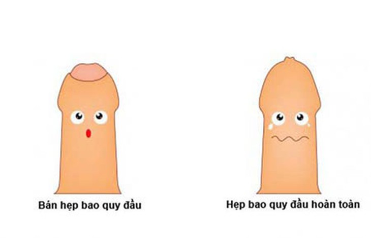 6 đối tượng dễ mắc ung thư dương vật - Ảnh 3.