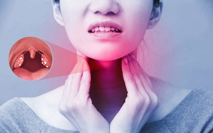 Đề phòng viêm amidan tái phát lúc thay đổi thời tiết - Ảnh 2.