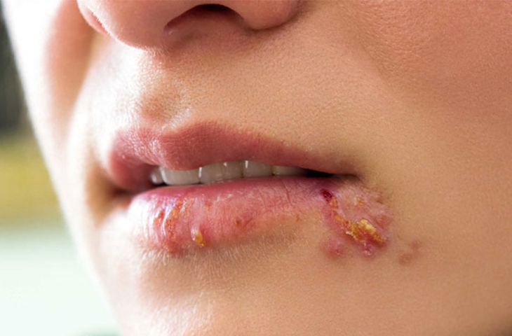 Có dùng acyclovir trị chốc mép? - Ảnh 1.