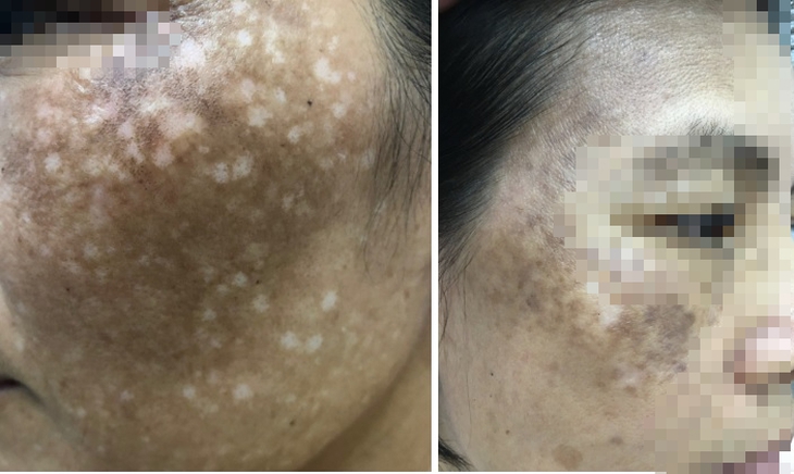 Nhiễm độc corticoid, da mỏng dính sau khi bôi kem trộn chữa nám - Ảnh 2.