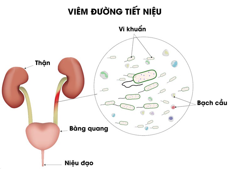 Điều trị viêm đường tiết niệu ở nam giới bao gồm diệt trừ những vi khuẩn gây bệnh và loại trừ hay hạn chế các yếu tố thuận lợi gây ra bệnh.