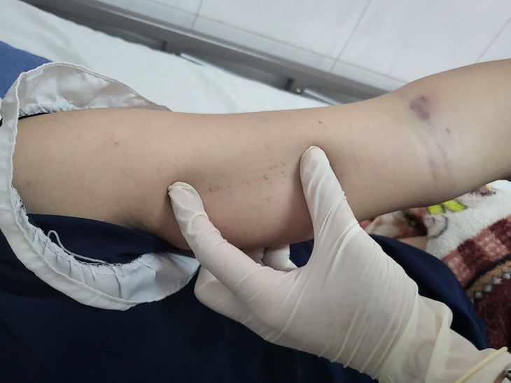 Đắk Lắk: Trong vòng 12 ngày ghi nhận 04 trường hợp tử vong do sốt xuất huyết - Ảnh 1. Đắk Lắk: Trong vòng 12 ngày ghi nhận 04 trường hợp tử vong do sốt xuất huyết - Ảnh 1.