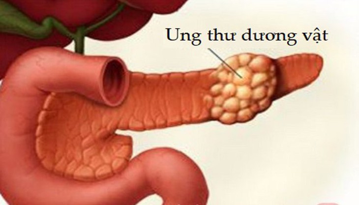 Những ảnh hưởng của ung thư dương vật đến đời sống tình dục - Ảnh 2.