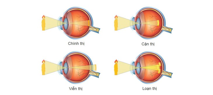 Tật khúc xạ thường có xu hướng phát triển tăng dần cho đến khoảng 18 - 20 tuổi thì dừng lại.