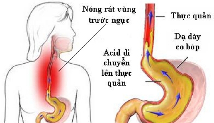 6 loại thực phẩm nên ăn tốt cho người bị trào ngược axit - Ảnh 2.
