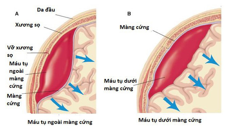 Sau ngã, va đập có biểu hiện đau đầu, nói ngọng, buồn nôn… thận trọng với tụ máu dưới màng cứng - Ảnh 2. Sau ngã, va đập có biểu hiện đau đầu, nói ngọng, buồn nôn… thận trọng với tụ máu dưới màng cứng - Ảnh 2.