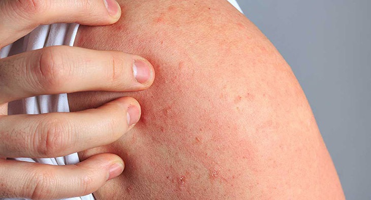 Từ vụ sốc phản vệ sau ăn cá thu, khuyến cáo những loại thực phẩm dễ gây dị ứng, cần thận trọng khi ăn - Ảnh 2. Từ vụ sốc phản vệ sau ăn cá thu, khuyến cáo những loại thực phẩm dễ gây dị ứng, cần thận trọng khi ăn - Ảnh 2.