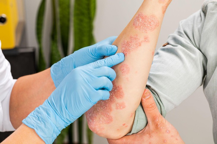 Viêm đa cơ và viêm da cơ là bệnh lý đặc trưng bởi tổn thương da và cơ có tính chất tự miễn.