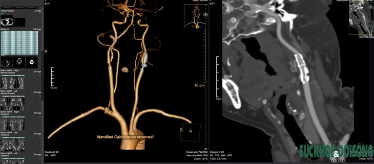 Bệnh viện ĐK TP Vinh ứng dụng máy CT.Scanner 256 lát cắt tầm soát bệnh tim mạch - Ảnh 2. Bệnh viện ĐK TP Vinh ứng dụng máy CT.Scanner 256 lát cắt tầm soát bệnh tim mạch - Ảnh 2.