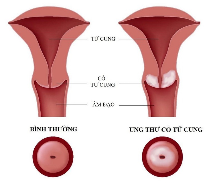 Cổ tử cung đóng vai trò rất lớn trong quá trình sinh sản và sinh lý bình thường của phụ nữ.