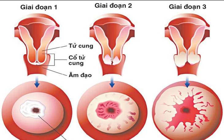 Nhận biết sớm ung thư cổ tử cung
