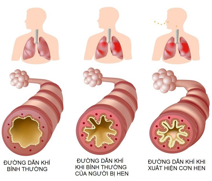 Chăm sóc trẻ bị hen phế quản và cách dự phòng cơn hen - Ảnh 2. Chăm sóc trẻ bị hen phế quản và cách dự phòng cơn hen - Ảnh 2.