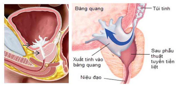 Xuất tinh ngược dòng, khi nào cần đến gặp bác sĩ? - Ảnh 2.