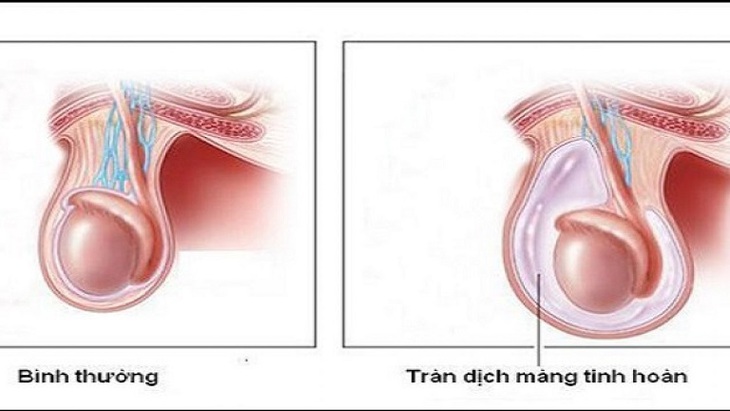 Căn bệnh hay gặp ở trẻ nhỏ dễ gây teo tinh hoàn, ảnh hưởng khả năng sinh sản - Ảnh 2. Căn bệnh hay gặp ở trẻ nhỏ dễ gây teo tinh hoàn, ảnh hưởng khả năng sinh sản - Ảnh 2.