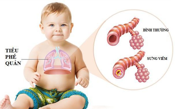 Viêm tiểu phế quản cấp ở trẻ: Con đường lây nhiễm và cách điều trị