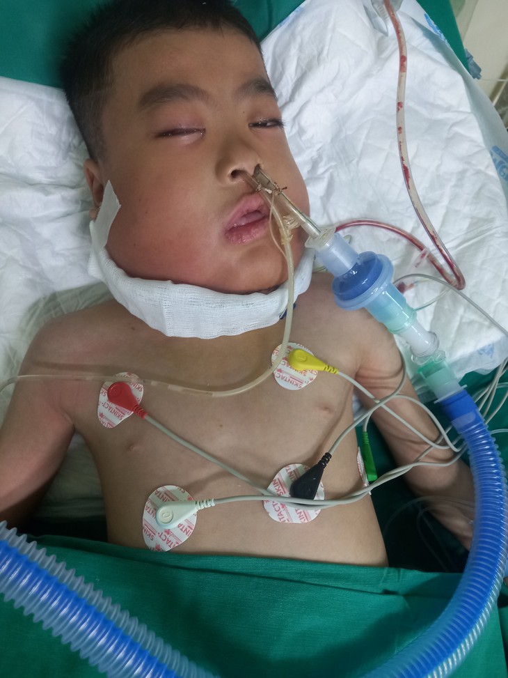 Hai anh em biến dạng khuôn mặt vì căn bệnh quái ác, không tiền điều trị - Ảnh 1. Hai anh em biến dạng khuôn mặt vì căn bệnh quái ác, không tiền điều trị - Ảnh 1.