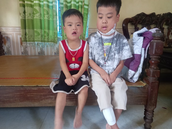 Hai anh em biến dạng khuôn mặt vì căn bệnh quái ác, không tiền điều trị - Ảnh 3. Hai anh em biến dạng khuôn mặt vì căn bệnh quái ác, không tiền điều trị - Ảnh 3.