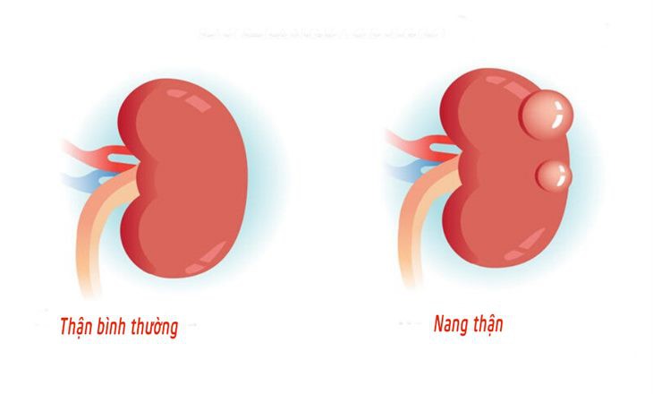 Nang thận có thật sự lành tính? Chuyên gia cảnh báo những dấu hiệu tuyệt đối không được bỏ qua- Ảnh 1.