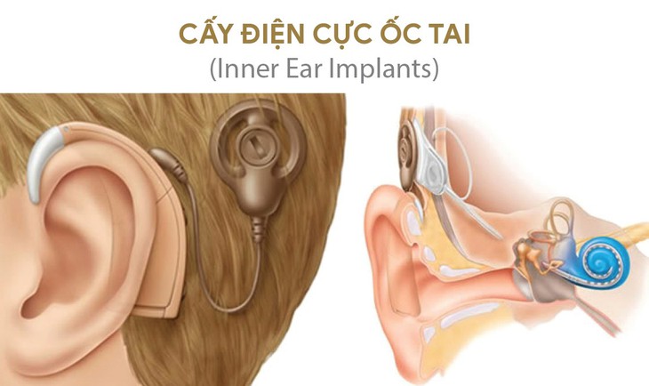 Phân loại nghe kém, các giải pháp hỗ trợ thính giác phù hợp - Ảnh 4.