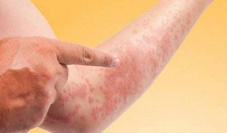Bệnh ngoài da là bệnh gây ảnh hưởng trực tiếp đến bề mặt da. Ảnh minh họa