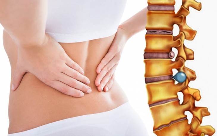 Chủ quan với gai cột sống có thể gây bại liệt