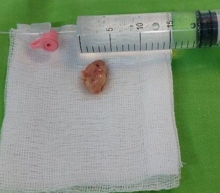 U tủy cột sống phát hiện qua đau lưng - Ảnh 1.