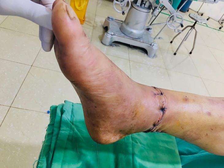 Suýt đứt lìa bàn chân do máy cắt cỏ - Ảnh 2. Suýt đứt lìa bàn chân do máy cắt cỏ - Ảnh 2.