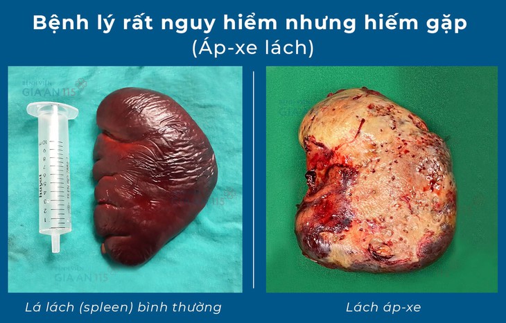 Áp-xe lách – bệnh lý rất nguy hiểm nhưng hiếm gặp đến mức bị…lãng quên - Ảnh 1. Áp-xe lách – bệnh lý rất nguy hiểm nhưng hiếm gặp đến mức bị…lãng quên - Ảnh 1.