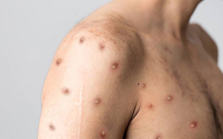 Hy hữu: Người đàn ông mắc cùng lúc 3 bệnh COVID-19, đậu mùa khỉ và HIV