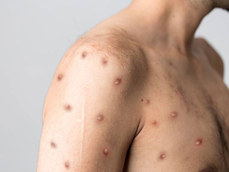 Hy hữu: một người đàn ông mắc cùng lúc 3 bệnh COVID-19, đậu mùa khỉ và HIV - Ảnh 1. Hy hữu: một người đàn ông mắc cùng lúc 3 bệnh COVID-19, đậu mùa khỉ và HIV - Ảnh 1.