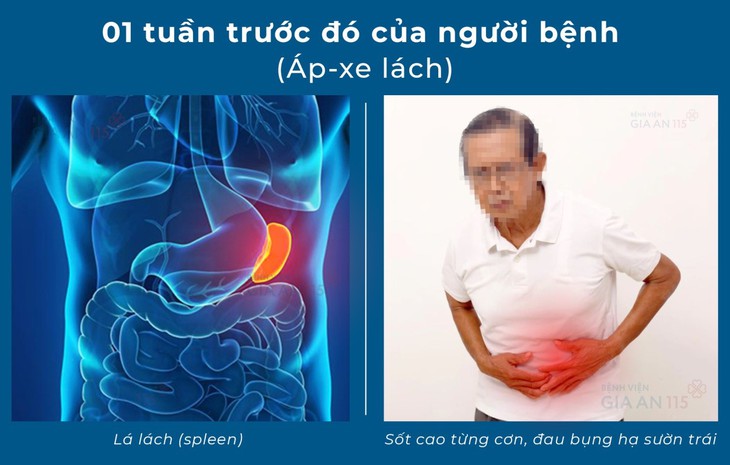 Áp-xe lách – bệnh lý rất nguy hiểm nhưng hiếm gặp đến mức bị…lãng quên - Ảnh 3. Áp-xe lách – bệnh lý rất nguy hiểm nhưng hiếm gặp đến mức bị…lãng quên - Ảnh 3.