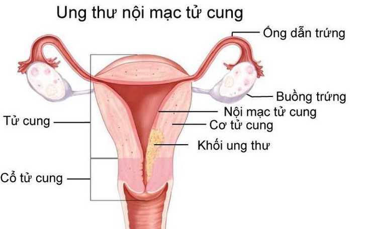 Ra máu âm đạo bất thường có phải là dấu hiệu ung thư? - Ảnh 2. Ra máu âm đạo bất thường có phải là dấu hiệu ung thư? - Ảnh 2.