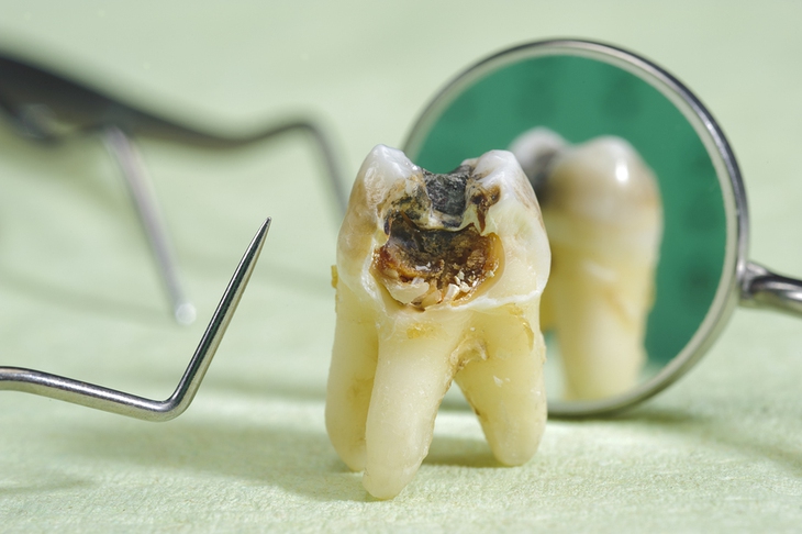 Thuốc gì giảm đau răng? - Ảnh 1.