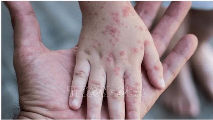 Di chứng tâm lý đè nặng lên bệnh nhân mắc đậu mùa khỉ - Ảnh 1.