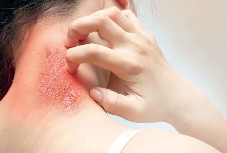 Nhận biết nhiễm khuẩn da thường gặp và cách xử trí - Ảnh 4.