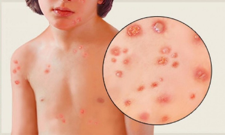Nhận biết nhiễm khuẩn da thường gặp và cách xử trí - Ảnh 2.