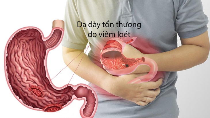Vì sao người có bệnh dạ dày, thực quản nên tránh thức ăn cay? - Ảnh 1. Vì sao người có bệnh dạ dày, thực quản nên tránh thức ăn cay? - Ảnh 1.