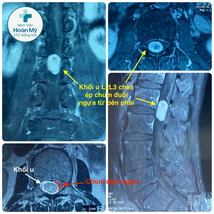 Phẫu thuật cắt bản sống một bên điều trị u bao sợi thần kinh (SCHWANNOMA) thành công cho nam bệnh nhân 59 tuổi - Ảnh 1.