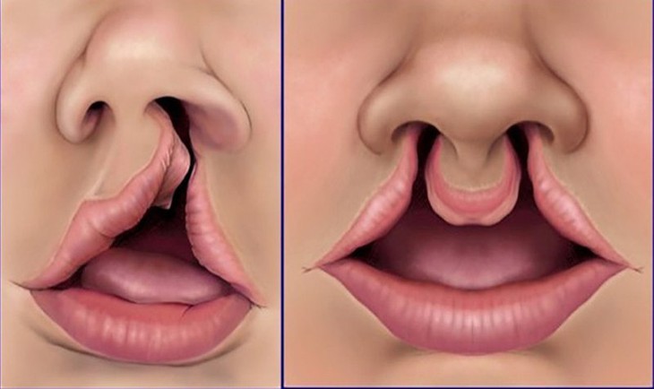 Những vấn đề thường gặp khi chăm sóc trẻ khe hở môi - vòm miệng - Ảnh 2.