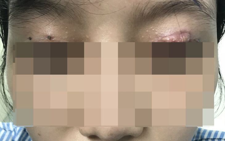 Cắt mí mắt ở cơ sở thẩm mỹ "chui", một phụ nữ bị hỏng mắt
